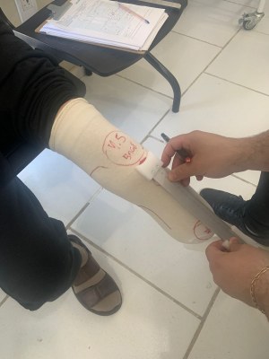 Oficina Ortopédica de Bagé está realizando medição de órtese e próteses